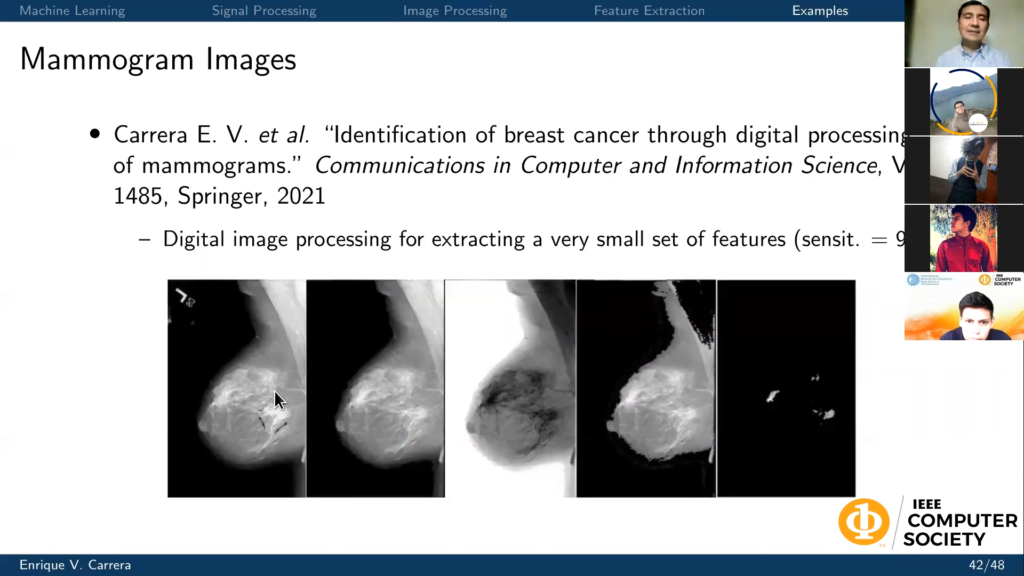 Imagen de Mamografía en el ML